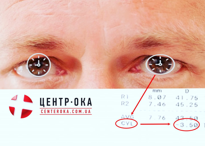 Астигматизм що це?