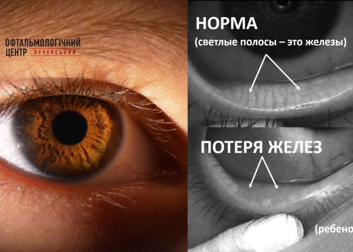 Схильність до хвороби сухого ока закладається з дитинства?