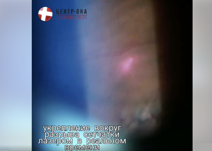 Укрепление сетчатки лазером без боли за секунды (Видео)