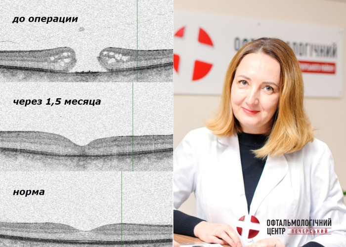Кто такие Витреоретинальные хирурги?