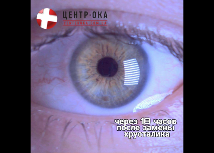 Як виглядає око менше ніж через добу після рефракційної заміни кришталика
