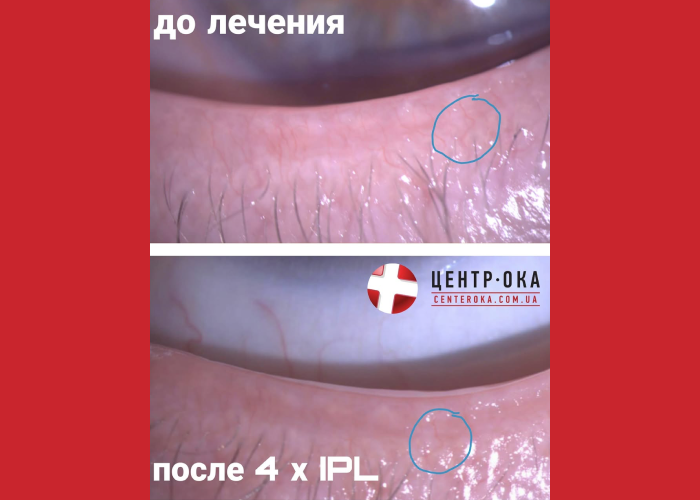 Глазная розацеа – что это? Как лечится?